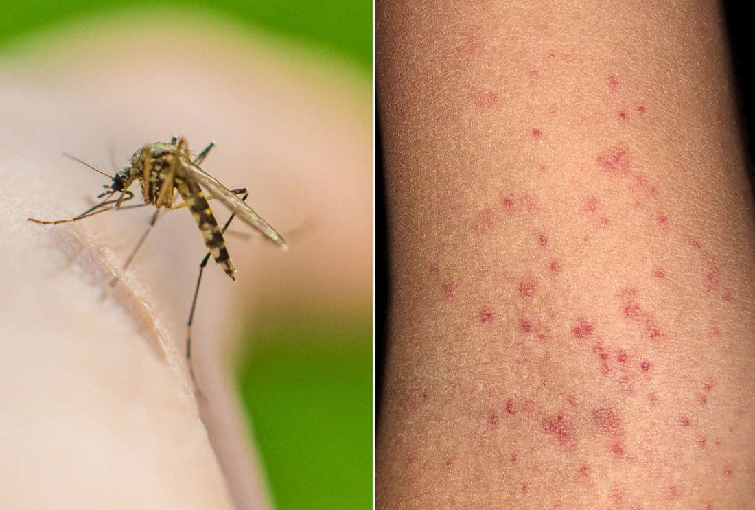 Rising Dengue Fever Cases in the UAE: How to Stay Safe from Mosquito Bites